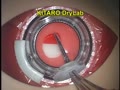 Evolving KITARO Surgical Training System-Development of "KITARO MultiLab" for, Surgical Training for Complicated Cataract Cases and Various Anterior Segment Surgeries-