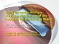Simple explantation technique of a sulcus phakic intraocular lens in a patient with bilateral angle closure