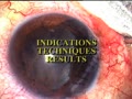 Surgical treatment of photophobia : indications, technic and results